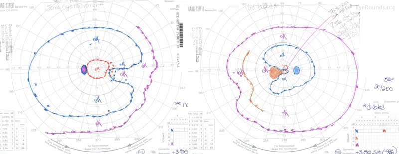 Goldmann visual fields (GVF), both eyes: OD- There was a constriction of the I2e isopter and a nasal step of the I4e isopter. Otherwise, the fields were full to the V4e isopter with no scotomas. OS- There was mild nasal constriction of the V4e, III4e, and I4e isopters, severe constriction of the I2e to ~2 degrees, and a paracentral scotoma to the III4e isopter.  