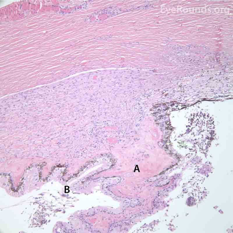 Pathological changes of the ciliary body in NVG. A- The ciliary body is atrophic with evidence of ciliary ablation and muscle necrosis. The ciliary processes in the pars plicata are coalesced in some areas. B- The surface is covered with a collagenous membrane that demonstrated some necrotic material and old red blood cells. The upper H&E image (10X) shows the location (black box) of the lower image (40X). 