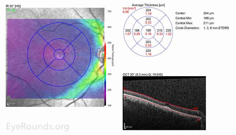 OCT OD (A) and OS(B) show diffuse retinal thinning with parafoveal atrophy of the outer retinal layers.  There is an area of subfoveal hyperreflective foci OU. 