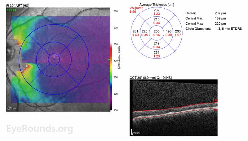 OCT OD (A) and OS(B) show diffuse retinal thinning with parafoveal atrophy of the outer retinal layers.  There is an area of subfoveal hyperreflective foci OU. 