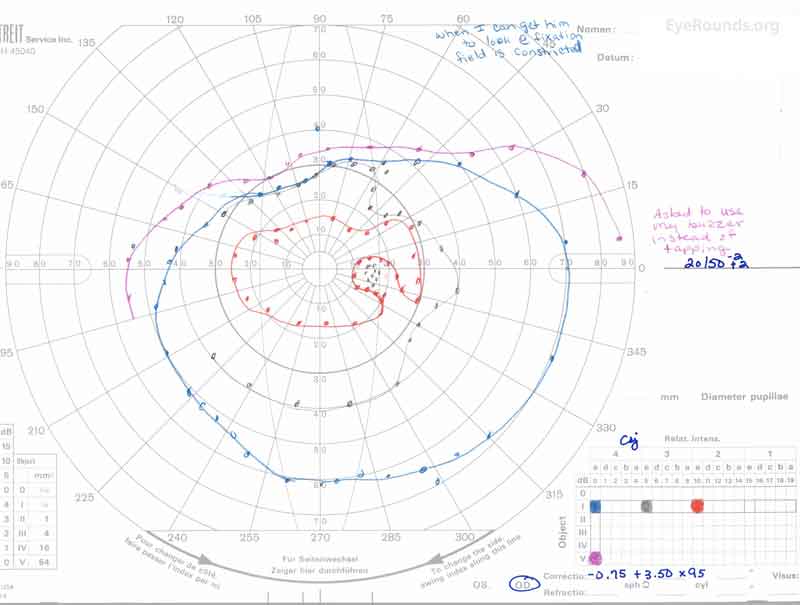 Goldmann Visual Field (GVF) OD (A) shows an overall full visual field to all isopters tested.