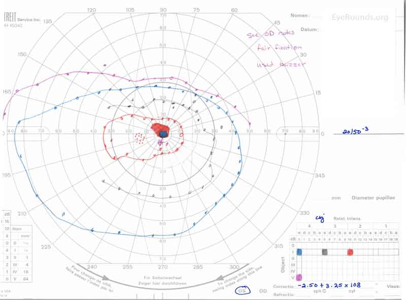 GVF OS (B) shows a 5 degree central scotoma to the I4e isopter centrally and the I2e isopter peripherally but otherwise a full visual field to all isopters tested. 