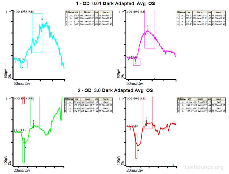 Figure 4A shows essentially normal dark adapted 0.01 cd.s/m2 rod responses and selective loss of the b-wave on 3.0 cd.s/m2 dark adapted responses.