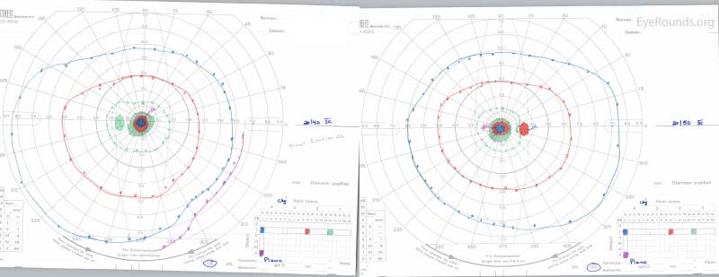 Goldmann Visual Fields. OD: Cecocentral scotoma to the I4e isopter; 
OS: Central scotoma to the I4e isopter.  