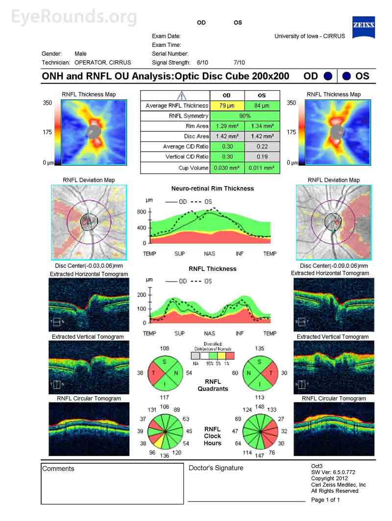 Optical Coherence Tomography (OCT) of the Optic Nerve Head. OD: Retinal nerve fiber layer (RNFL) thickness was 82 microns. There was RNFL thinning temporally, superiorly, and inferiorly; OS: RNFL thickness was 88 microns. There was RNFL thinning temporally, superiorly, and inferiorly.