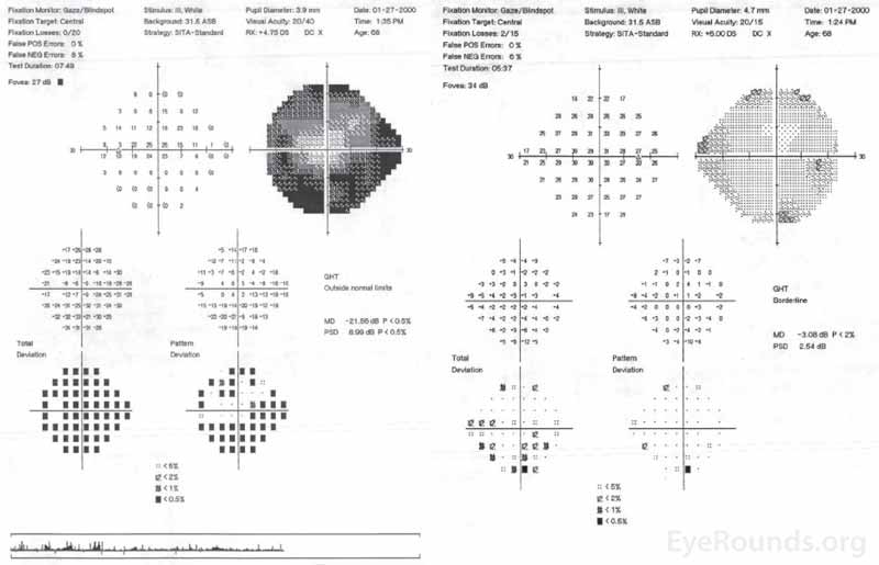 Central 24-2 Humphrey visual field, OU. OD (right HVF): Scattered non-specific depression, otherwise full. OS (left HVF): Dense superior and inferior arcuate loss with significant generalized depression. 