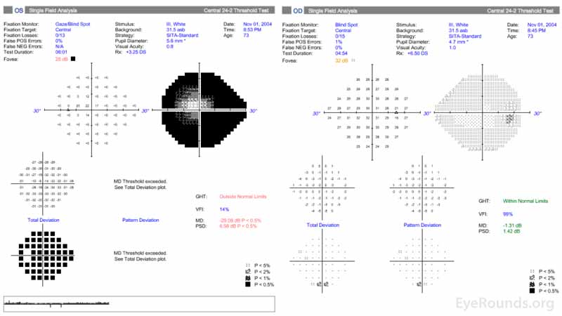 Central 24-2 Humphrey visual field, OU. OD (right HVF): Scattered non-specific depression, otherwise full. OS (left HVF): Dense superior and inferior arcuate loss with significant generalized depression. These visual fields represent a significant worsening OS despite having two prior trabeculectomies. 