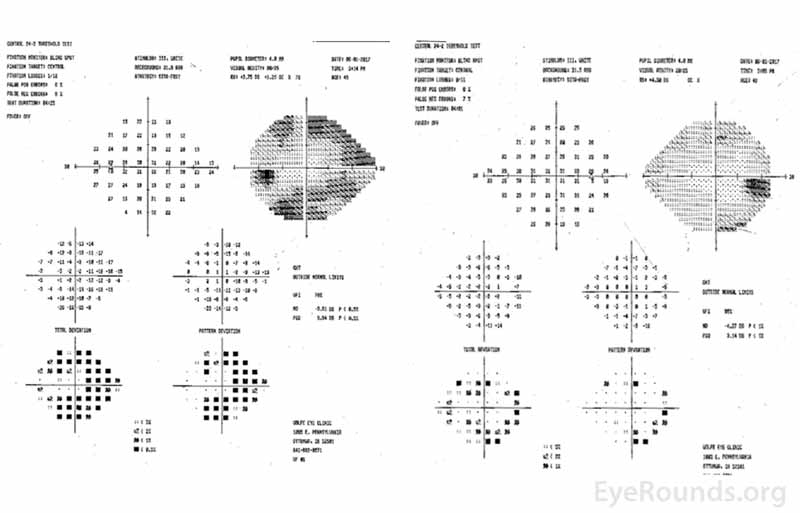 Central 24-2 Humphrey visual fields, OU. Left image: There were dense superior and inferior arcuate defects OS. Right image: Early inferior and superior arcuate defects OD were present.