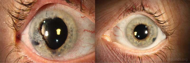 Anterior segment photographs at post-operative week 1 after cataract extraction OD. Left image: The right eye shows post-surgical changes of the iris with a peripheral iridotomy. However, the anterior chamber remained deep and the lens was centered in excellent position. Right image: The left eye shows a peripheral iridotomy with a deep anterior chamber and a lens centered in excellent position.