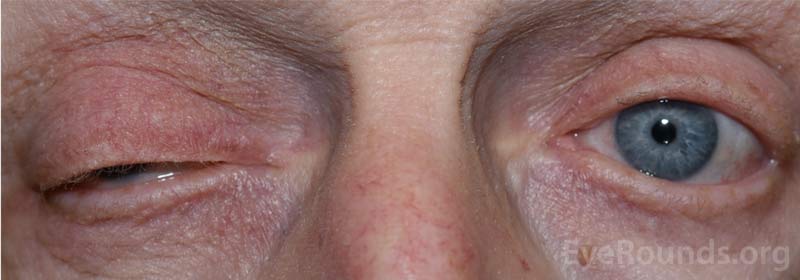 External photograph demonstrating right upper eyelid ptosis.