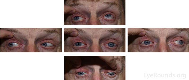 External 5-gaze photographs demonstrating the decreased motility of the right eye in all directions except for abduction.