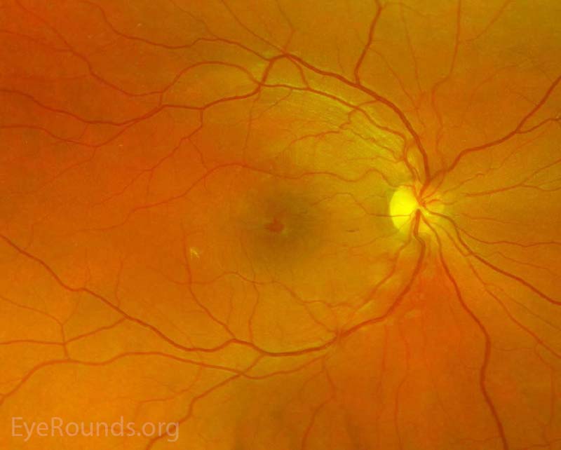 Pseudocolor fundus photos OD (left image) and OS (right image) three days after initial presentation. There were central petalloid lesions with blunted foveal reflexes OU. 