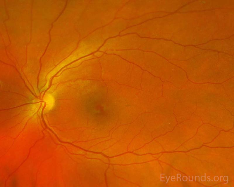 Pseudocolor fundus photos OD (left image) and OS (right image) three days after initial presentation. There were central petalloid lesions with blunted foveal reflexes OU. 