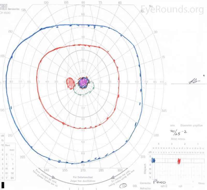 Goldmann Visual Fields (GVF) OU three days after initial presentation. There was a five-degree central scotoma to the V4e isopter OU. There was superior constriction of the I1e isopter OS (left image).