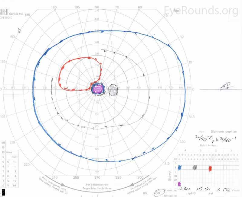 Goldmann Visual Fields (GVF) OU three days after initial presentation. There was a five-degree central scotoma to the V4e isopter OU. The I2e isopter was also constricted with complete loss of the I1e isopter OD (right image).