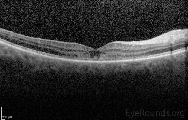 Optical Coherence Tomography (OCT) of OD (upper image) and OS (lower image) three days after initial presentation. In both eyes, there was a parafoveal band of hyperintensity in the outer nuclear layer, outer plexiform layer and inner photoreceptor segments/outer photoreceptor segments junction. There was disruption of the inner segment/outer segment junction subfoveally OU. 