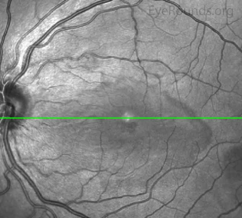 Near Infrared Image of OD (upper image) and OS (lower image) three days after initial presentation. In both eyes, there was a well demarcated hyporeflective petalloid lesion in the macula.