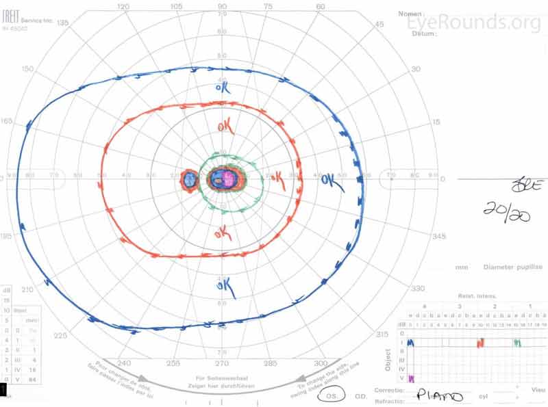 Goldmann Visual Fields (GVF) OU two months after initial presentation. There was slight improvement of the patient's bilateral central scotomas. 