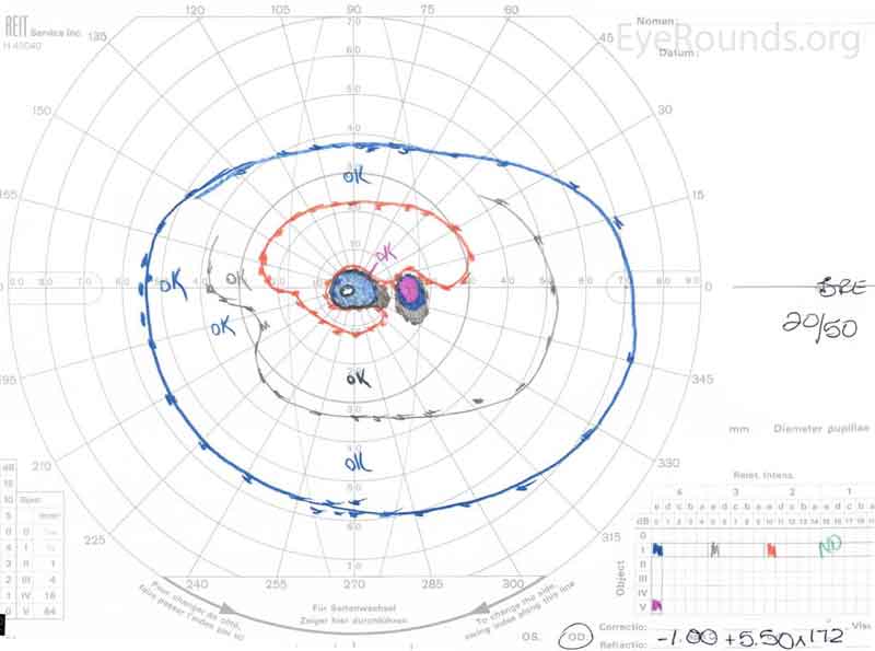 Goldmann Visual Fields (GVF) OU two months after initial presentation. There was slight improvement of the patient's bilateral central scotomas. 