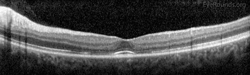 Optical Coherence Tomography (OCT) OD (upper image) and OS (lower image) two months after initial presentation. There was parafoveal thinning of the outer retina OU, but there was re-establishment of the inner segment/outer segment junction subfoveally OU.