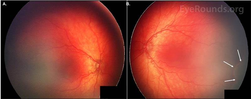 ROP with dilated veins and tortuous arteries in the posterior pole, OU