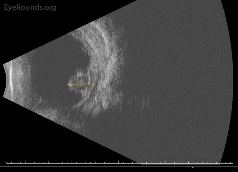 B-scan of a retinal detachment in stage 4 ROP. 