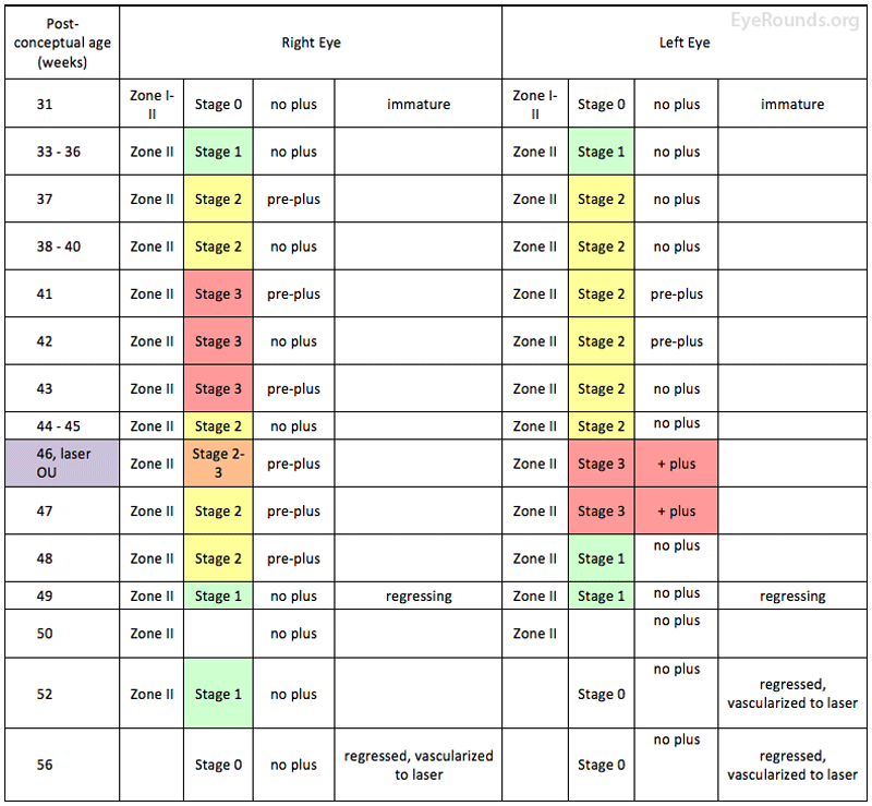 Table 1. Clinical course of premature infant showing the location, stage, and severity of ROP over time. The patient underwent LIO photocoagulation OU at post-conceptual age 46 weeks, at which time there was stage 3 ROP in zone II OU with bilateral dilatation and tortuosity of the posterior pole vessels, consistent with pre-plus OD and plus disease OS.