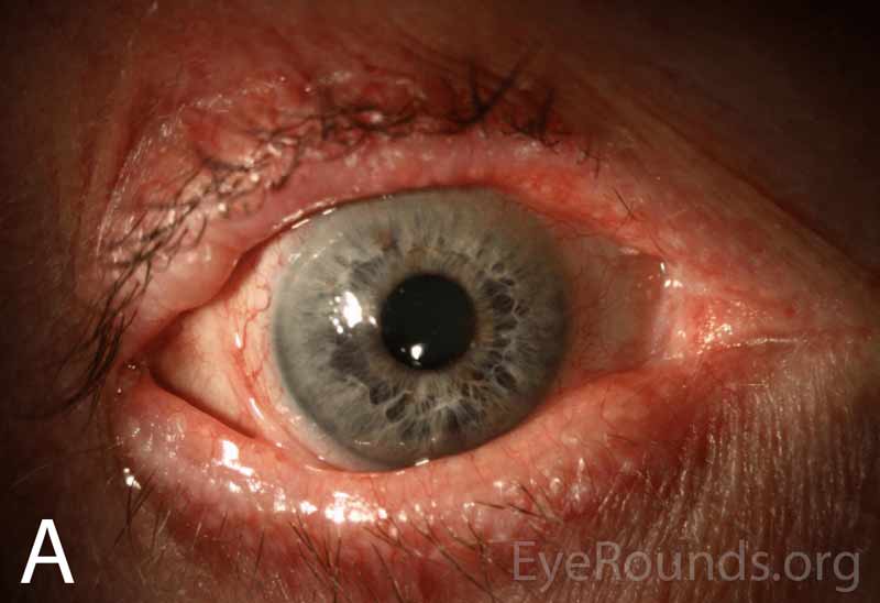 Wide-field slit lamp photographs of the right and left eyes at initial presentation. Note the irregularity and thickening of the eyelid margins, eyelid telangiectasias, punctal fibrosis, MGD, diffuse injection, bulbar conjunctival banding temporally consistent with symblepharon, and keratinization of the plica and caruncle nasally. There is superior corneal pannus in the right eye (A).