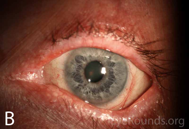 Wide-field slit lamp photographs of the right and left eyes at initial presentation. Note the irregularity and thickening of the eyelid margins, eyelid telangiectasias, punctal fibrosis, MGD, diffuse injection, bulbar conjunctival banding temporally consistent with symblepharon, and keratinization of the plica and caruncle nasally.