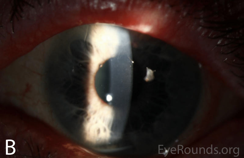 Slit lamp photographs of the right and left eyes at initial presentation. In both eyes, note diffuse epithelial haze and scattered punctate epithelial erosions.