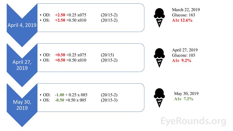 Refractive state relative to hemoglobin A1c over time after implementation of long-acting insulin regimen