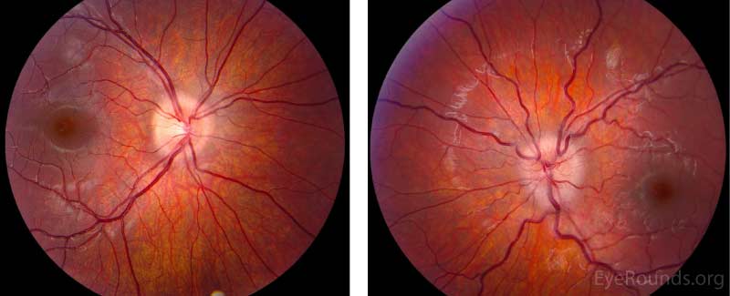 Dilated Fundus Examination