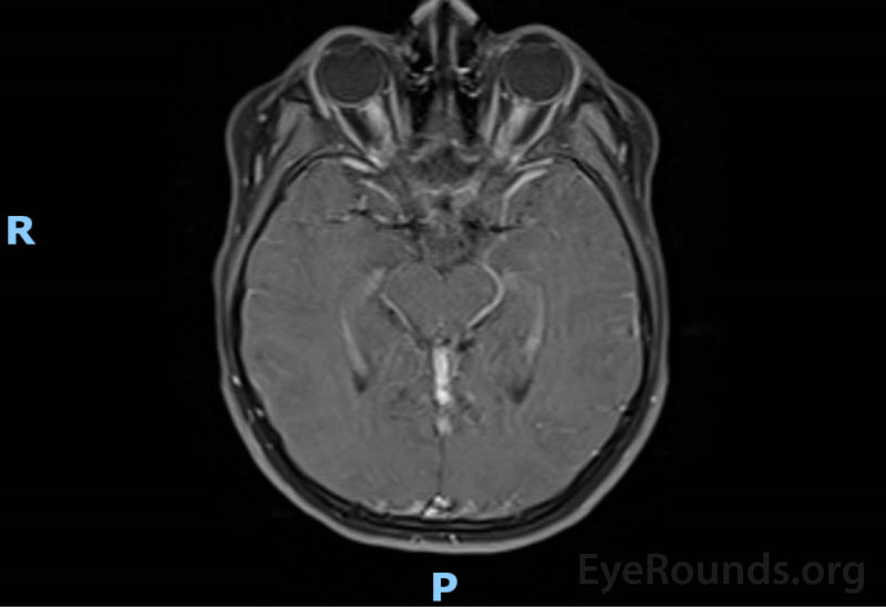   MRI brain and orbits w/ and w/o contrast