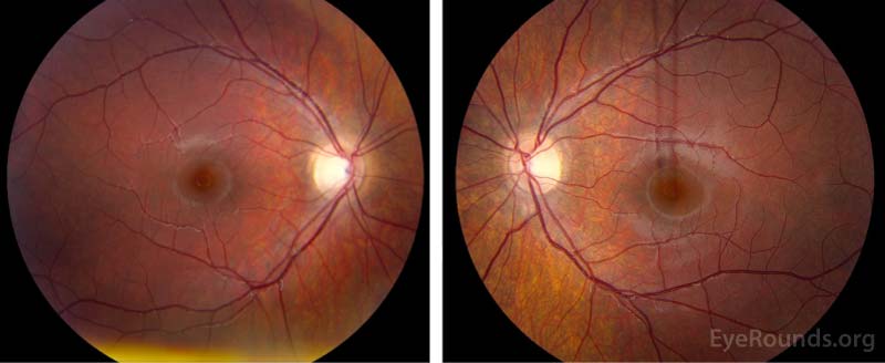 Dilated Fundus Examination post 1 month