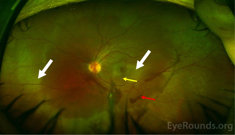 Color fundus photograph