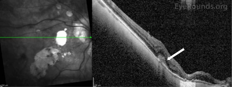  Optical coherence tomography (OCT) of the macula at presentation showing subretinal hyperreflective material overlying a small break in Bruch's membrane (arrow). Note that the choroid is very thin.