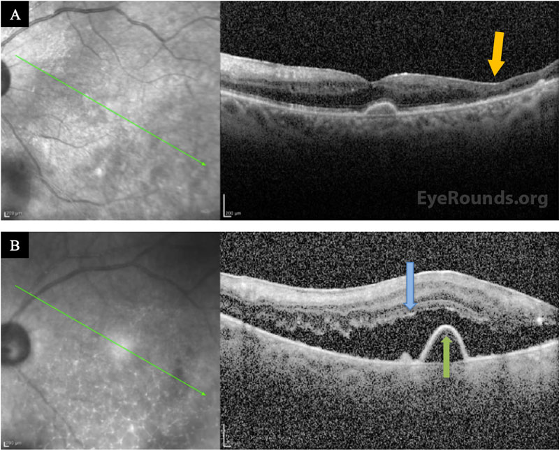 Optical coherence tomography of the right (A) and left (B, C) eyes on presentation.