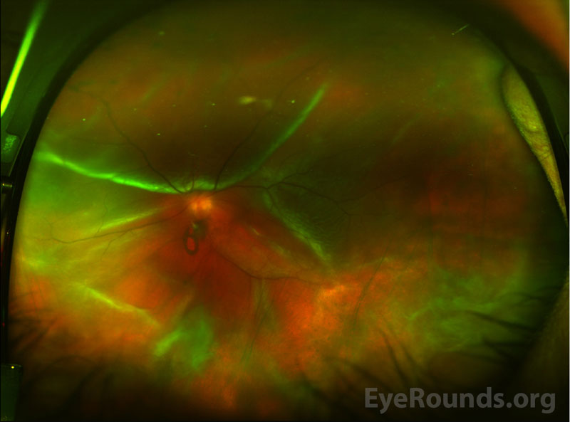 Optos fundus photography of the left eye two months after initial presentation with a superior macula involving retinal detachment.