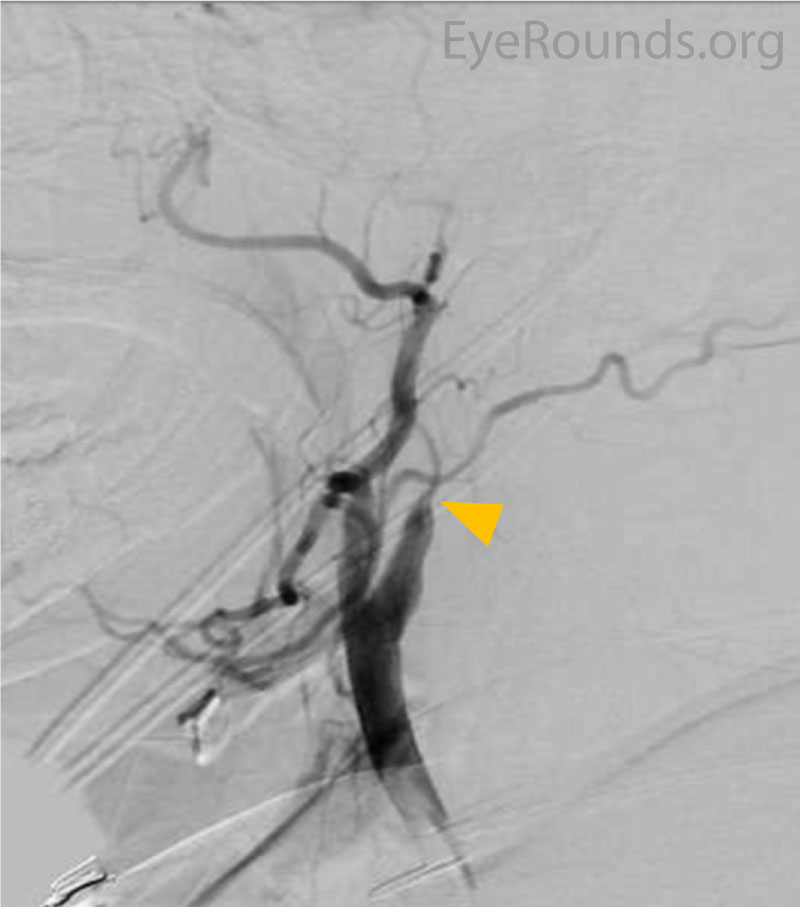 Cerebral angiogram