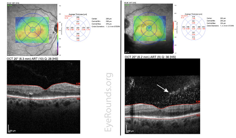 Optical coherence tomography (OCT)