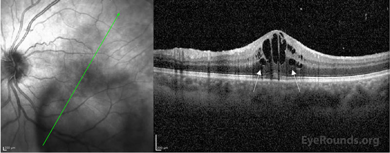 Optical coherence tomography of the left eye at presentation demonstrating well-defined cystic fluid pockets (white arrows) within the outer nuclear/outer plexiform layers and the inner nuclear layer. 