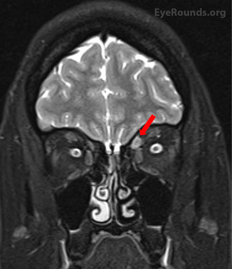 MRI orbits demonstrates moderate thickening and enhancement of the left superior oblique muscle