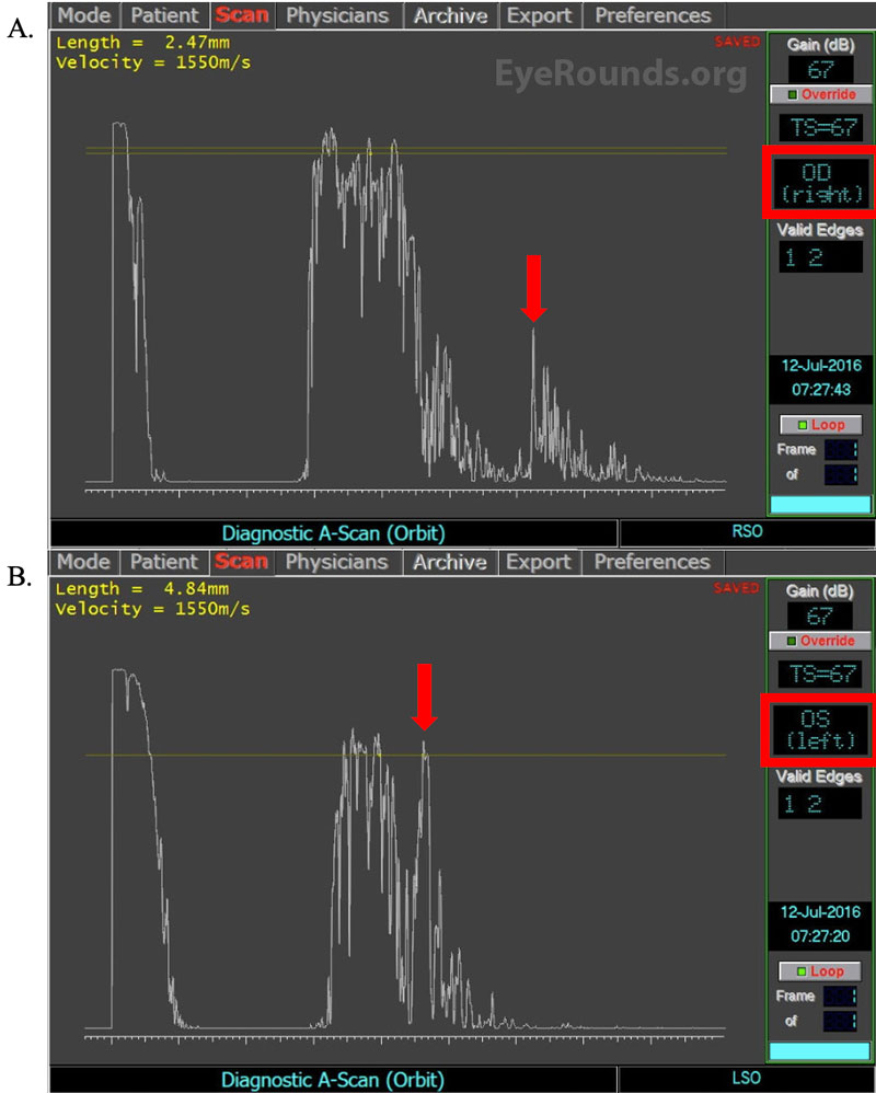 A-Scans of the (A) right and (B) left orbits