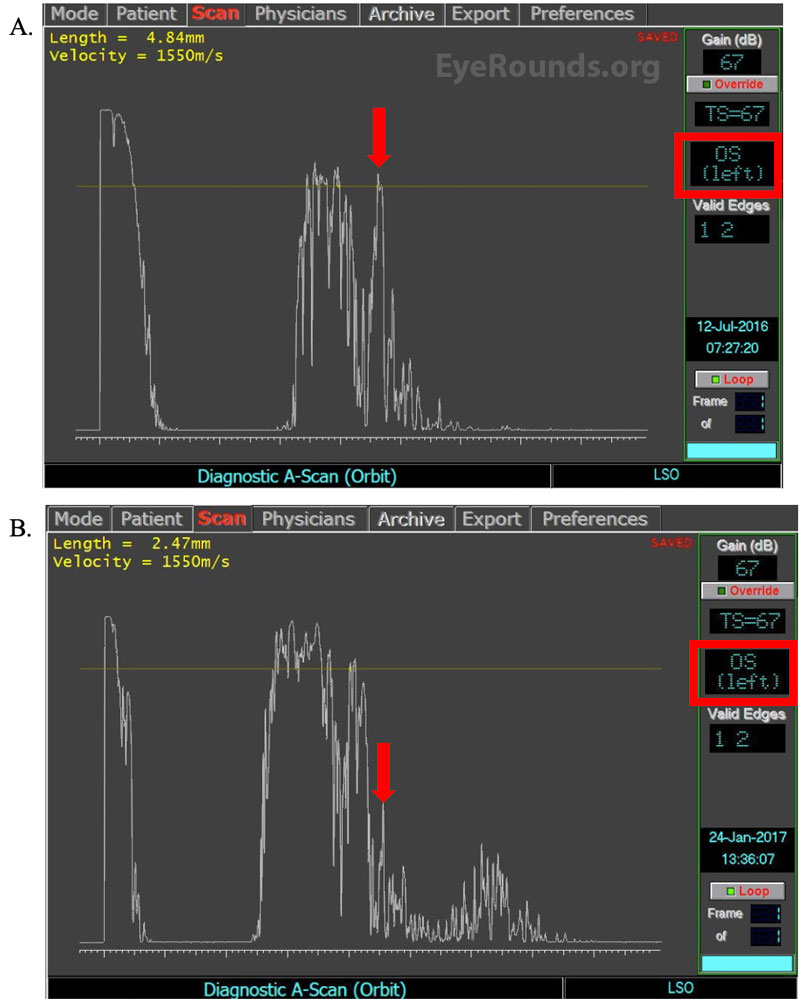 A-Scans of the left orbit before and after trigger point injection