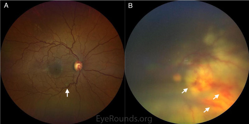 Clarus color fundus photography