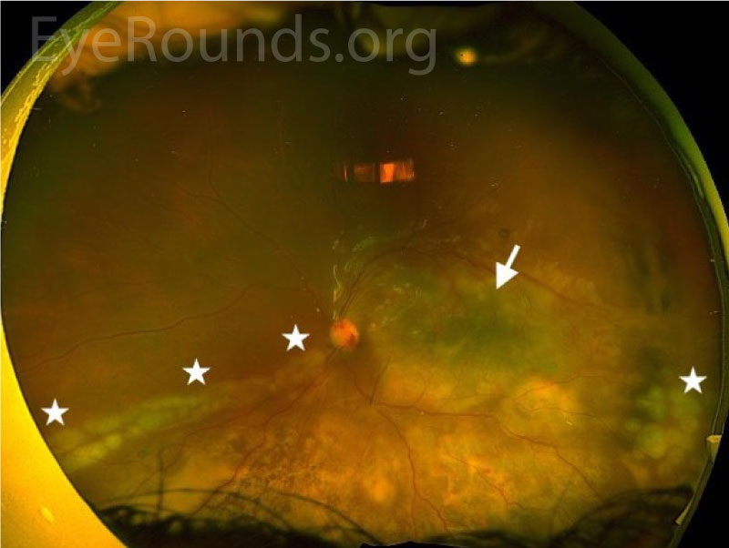 Optos ultra-wide field fundus photography, OS
