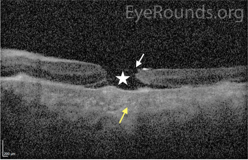 OCT of left eye 1 week after surgery