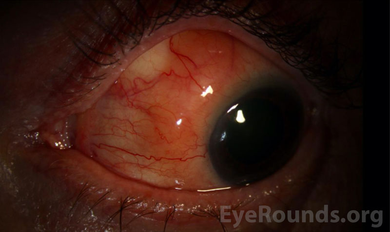 Slit Lamp Photography of the left eye shows a salmon-colored, elevated, subconjunctival infiltrate