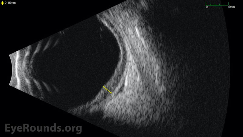 B-scan ocular ultrasound OS