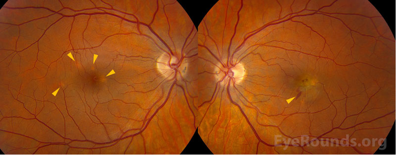 Clarus color fundus photography, OU